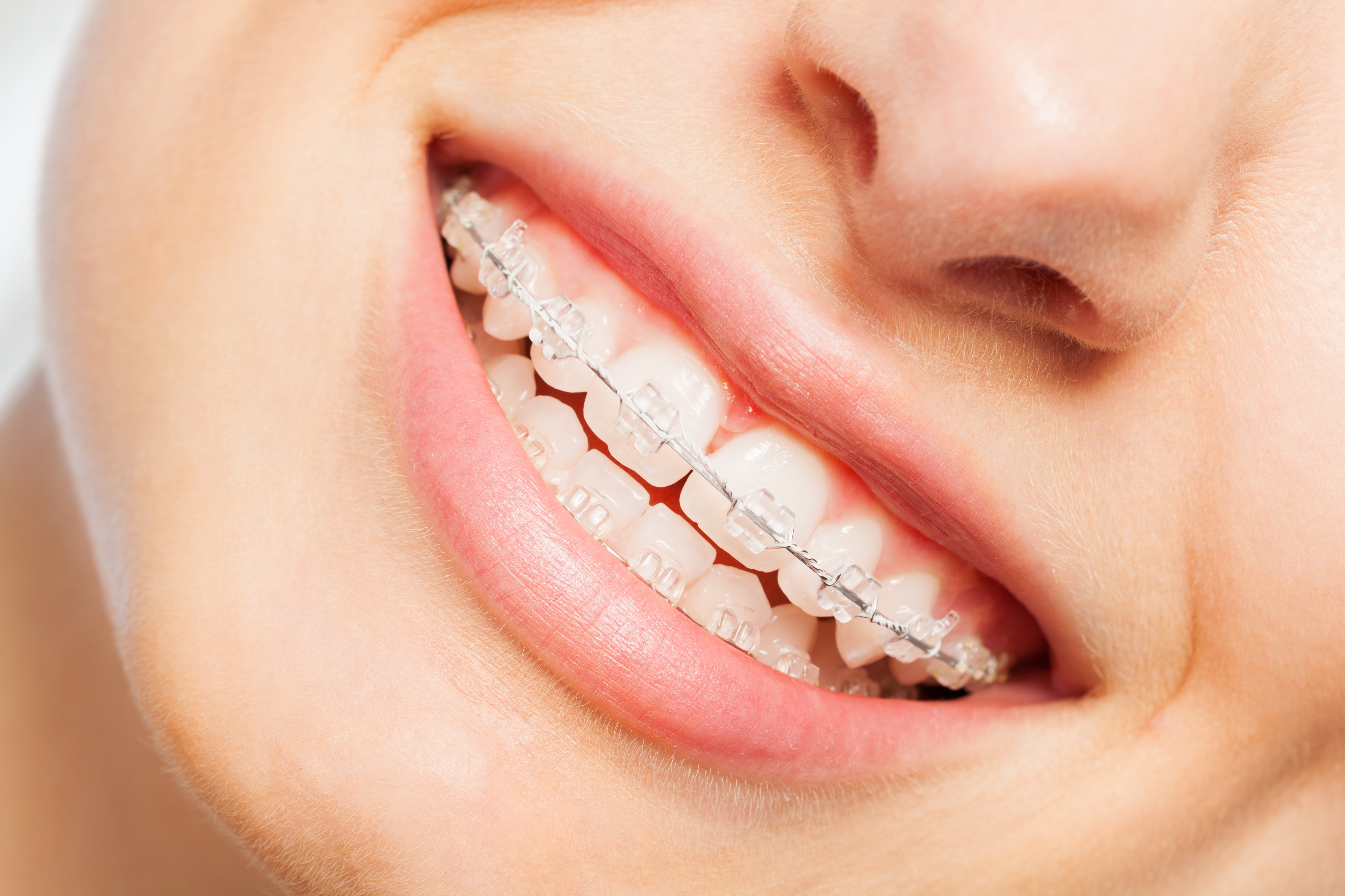 Teeth with traditional braces on them smiling at the camera showing braces for teens.