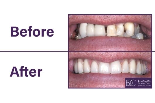 Stephen’s Dental Implant Story Before & After