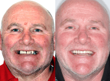 Dental implant treatment: Stephen’s story