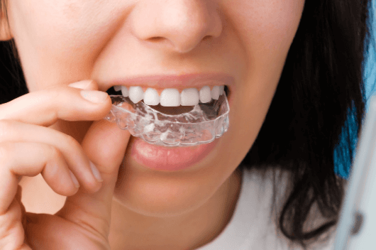 How To Use Invisalign Cleaning Crystals