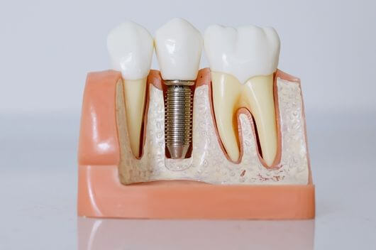 3 Reasons To Replace Missing Teeth With Dental Implants