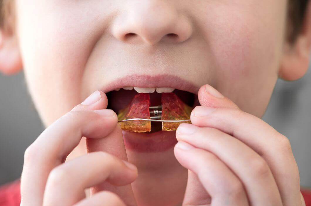 A child placing a pair braces in his mouth