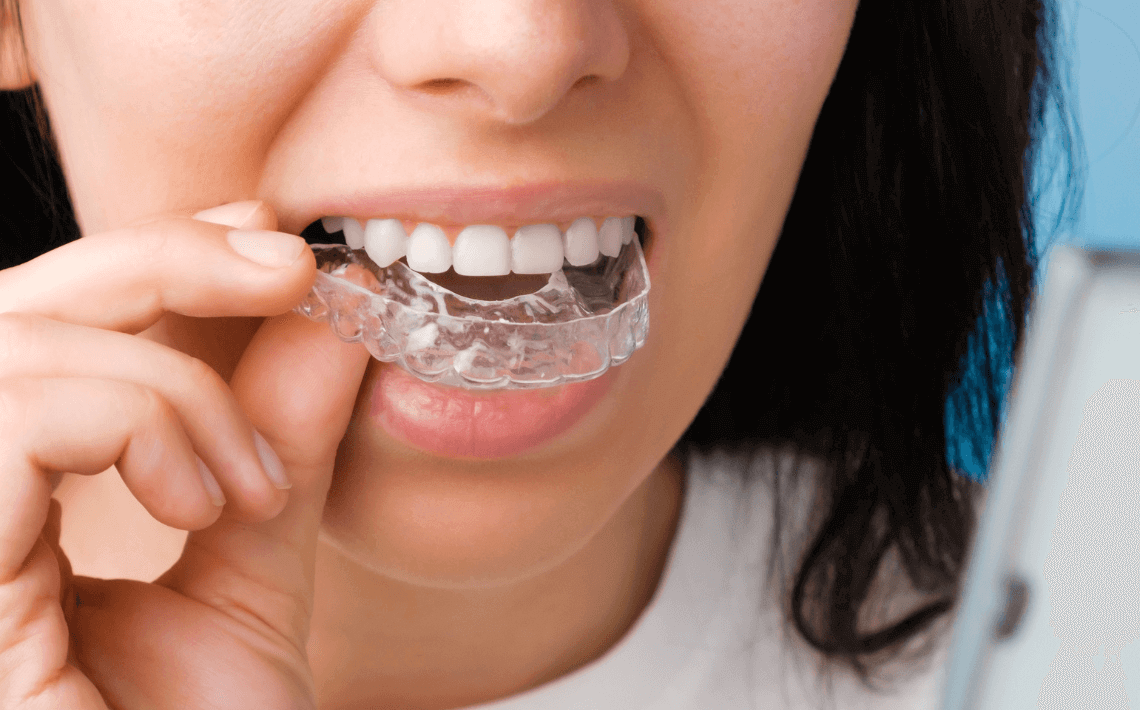 A woman who had decided between Invisalign and Metal Braces and chosen Invisalign, she is wearing the clear aligners.