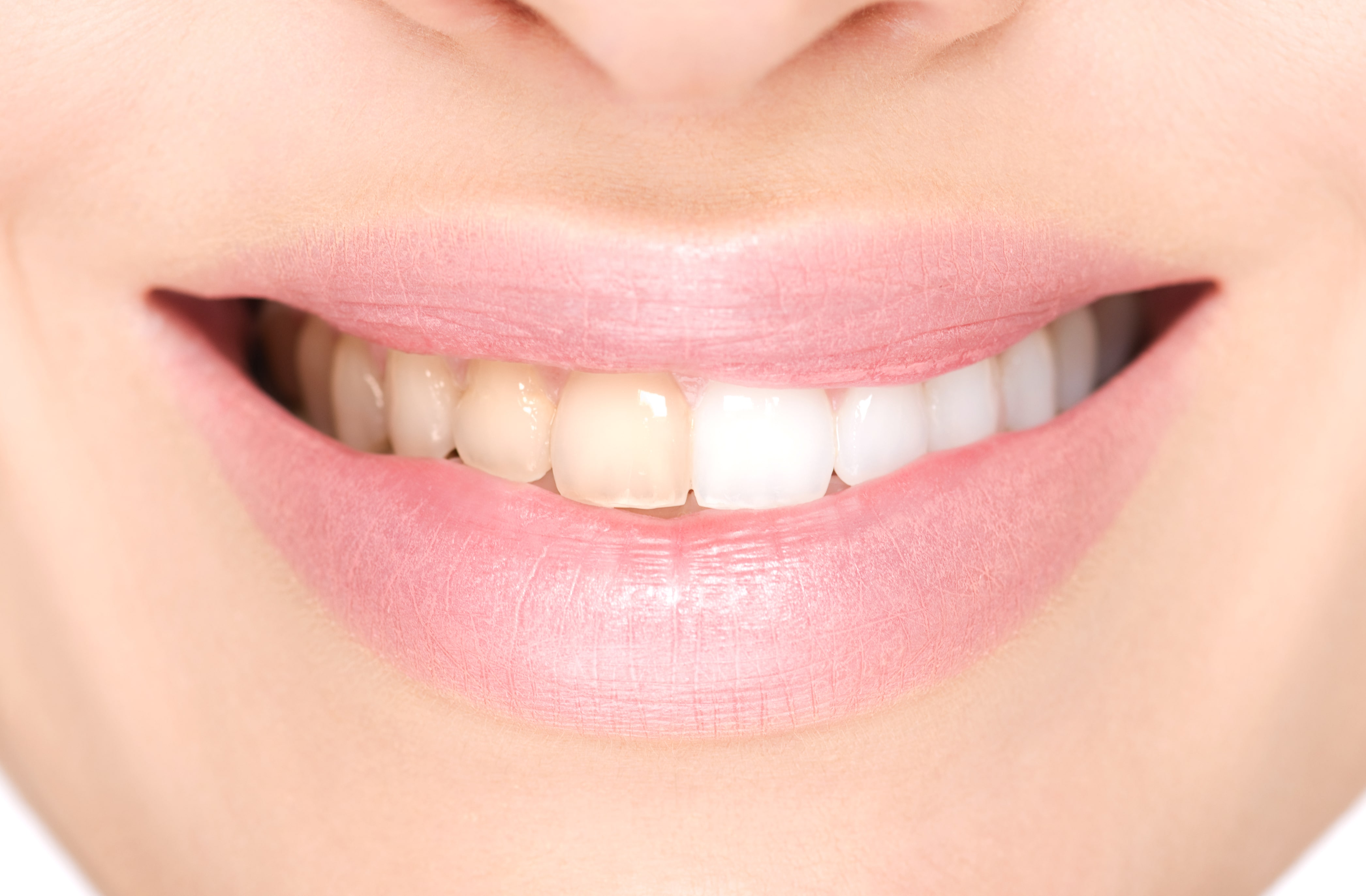 A photo of teeth before and after teeth whitening, a cosmetic dental procedure, with us here at Blossom Dental Care.